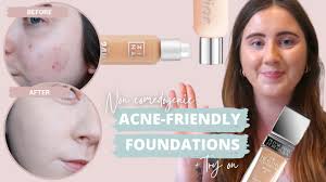 best foundations for acne acne