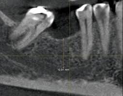 a cbct scan for implant placement