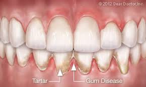 periodontist for your gum disease