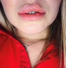 woman s lip filler disaster left her