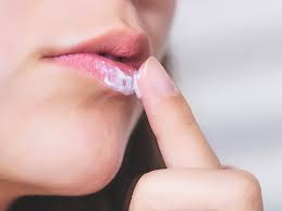 popping a cold sore is it bad what to