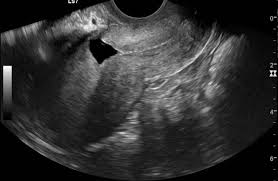 Cesarean scar pregnancy (csp) is a rare condition that occurs when the pregnancy implants in a complications were more frequent in women with a history of three or more cesarean section. Cesarean Section Scar Diverticulum Radiology Case Radiopaedia Org