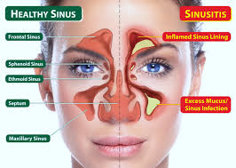sinusitis faqs ent specialty care