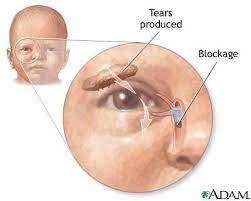eye discharge in the newborn