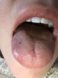 black spot on my tongue
