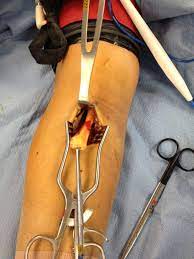 distal biceps tendon rupture of the