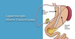 laparoscopic sleeve gastrectomy for