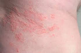Dec 12, 2018 · intertrigo is a rash caused by fungus, bacteria, or yeast. Inverse Psoriasis Vs Intertrigo Symptoms Causes And Identification