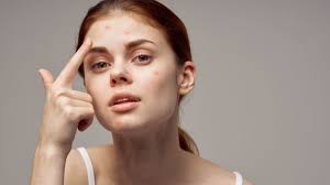 oily acne e skin