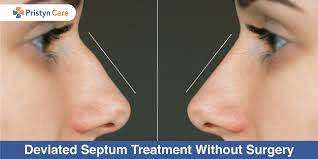 deviated septum treatment without