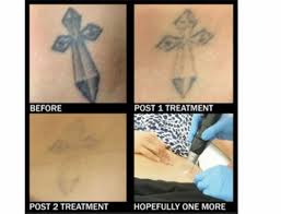 permanent tattoo removal treatment