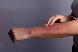 how long do hiv rashes last symptoms