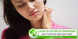 how to get rid of ringworm home
