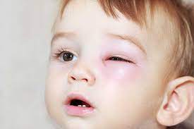 eye swollen legacy pediatrics