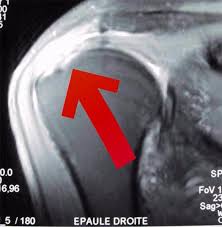Il n'est pas rare que des fissures apparaissent dans les tendons de l'épaule (ruptures de la coiffe des rotateurs), en particulier à un âge avancé. Chirurgie Reparatrice Epaule Chirurgien Orthopediste Saint Omer 62