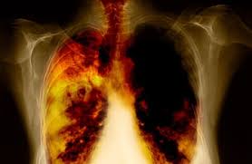 By stage 4, cancerous cells have spread beyond the lung where the cancer initially developed. Lung Cancer English Detiksehat