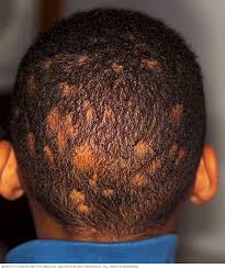 Rashes are abnormal changes in skin color or texture. Ringworm Scalp Symptoms And Causes Mayo Clinic