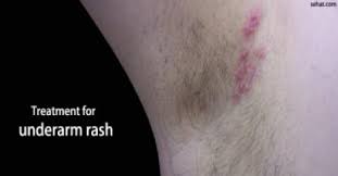 natural remes to treat armpit rash