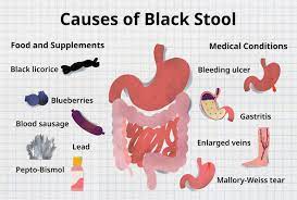 why is my black causes of tarry stool