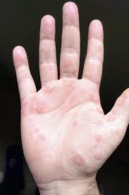 There are a few different causes for the condition, such as pregnancy and liver cirrhosis. Atypical Erythema Multiforme Palmar Plaques Lesions Due To Sars Cov 2 Janah 2020 Journal Of The European Academy Of Dermatology And Venereology Wiley Online Library