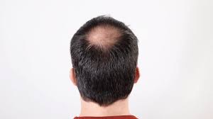 one male hair loss treatment works