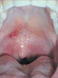 throat pain and red spots on palate
