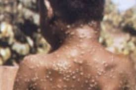 The risk of catching monkeypox in the uk is very low. Uzxjdlhk8zh44m