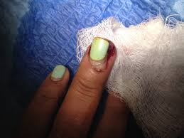 in patients with partial nail avulsion
