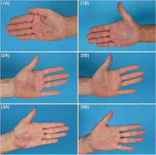 atopic hyperkeratotic hand eczema