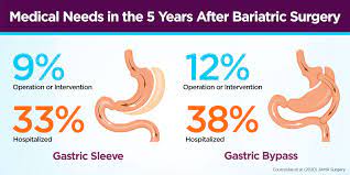 gastric byp than gastric sleeve