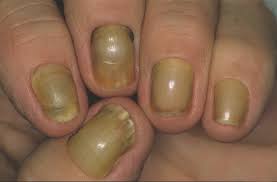 yellow nail syndrome clinical