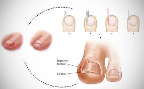 common nail problems ingrown nails