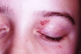 recur rash on eyelid cause for