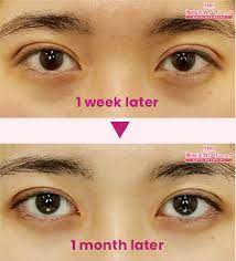 instant double eyelid surgery shonan
