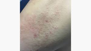why do hives occur with hiv