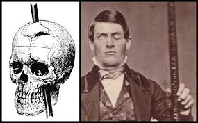 Phineas Gage s Story in Psychology  Brain Damage   Personality     Harvard Gazette   Harvard University Phineas Gage   His Amazing Story