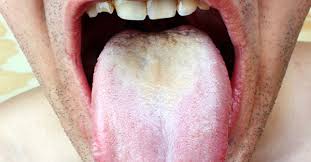 white stuff growing in your mouth