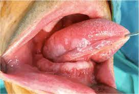 squamous cell carcinoma of the tongue