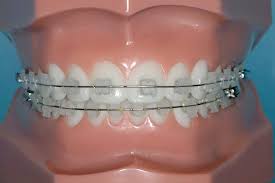 「歯科矯正 ブラケット 白」の画像検索結果