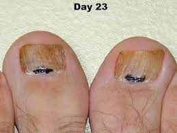 dhaa serum applied to toenail fungus