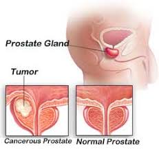 prostate cancer and erectile
