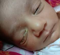 newborn ever had yellow sticky eyes