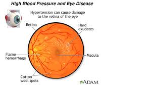 Ocular Effects Of Hypertension