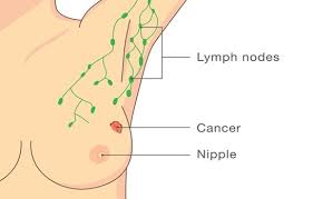 sentinel lymph node biopsy in t