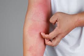 eczema vs dry skin how to tell the