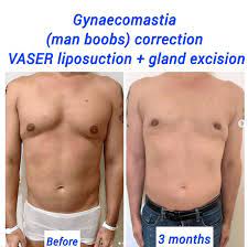 weight after vaser liposuction