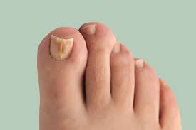 how to treat fungal nail effectively