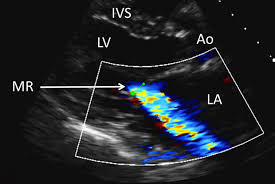 Chronic mitral regurgitation ultimately causes pulmonary hypertension, pulmonary edema and systolic heart failure. Mitral Valve Disease Clinical Review Gponline