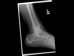 fibula fracture with ankle swelling