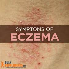 eczema characteristics causes